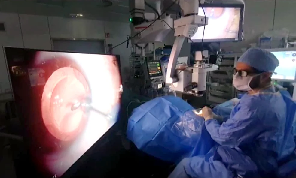 Dr Serdal Sanak au microscope opératoire pendant une chirurgie du cristallin, l'écran affiche la vue intraoculaire
